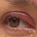 Image of Jačmeň na&nbsp;oku vie riadne potr&aacute;piť. Ako sa ho r&yacute;chlo zbav&iacute;te? | News.sk