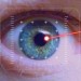 Image of Podstata každého laserového odstránenia dioptrií spočíva v úprave hrúbky očnej rohovky
