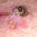 Image of Spinocelulárny karcinóm, rakovina kože spôsobená aj opaľovaním